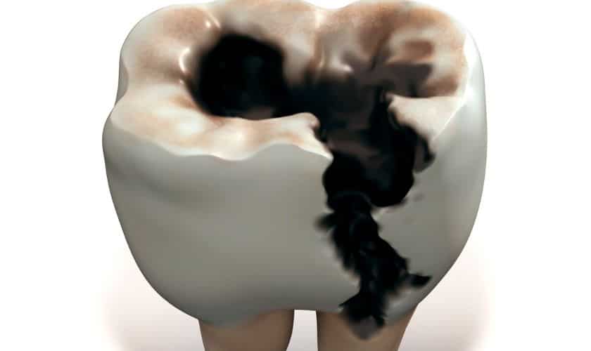 What to Know About Reversing Tooth Decay